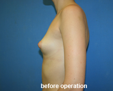 plastic-surgery-breast-augmentation